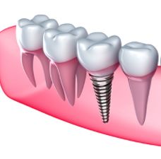 implantologia a milano dentista