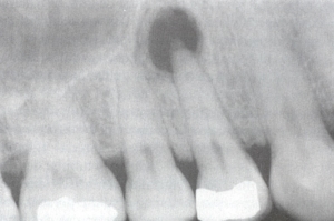 apical granuloma