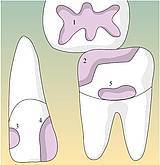 Caries