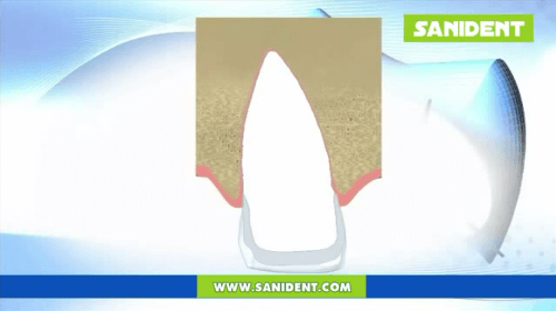 Video - Fractured or chipped tooth