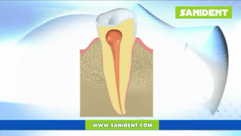 Video - Granuloma apicale e cisti dentale