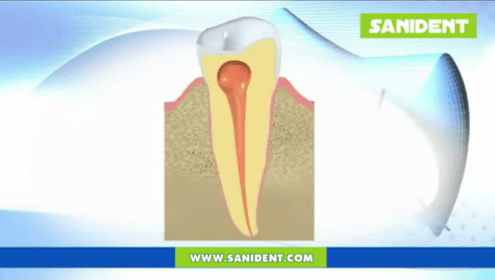 Footage - Apical granuloma and dental cyst