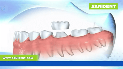 Footage - Corona or Capsule fixed prosthesis