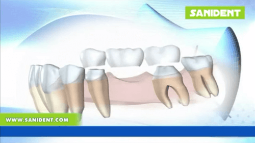 Footage - Fixed prosthesis The bridge