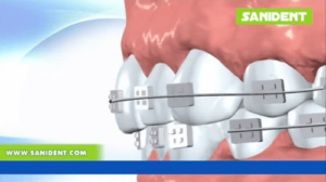 Video - Crooked Teeth and Orthodontics
