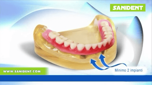 Footage - Dental implant