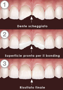 Dental bonding