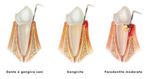 Gengivite vs Parodontite