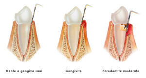 Gingivitis vs Periodontitis