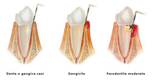 Gengivite vs Parodontite