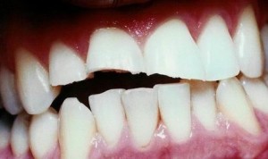 Denti rotti