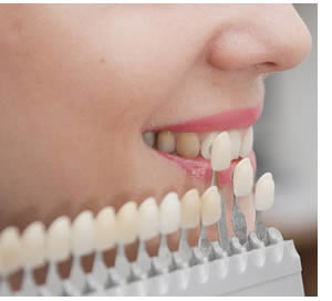 Dental veneers