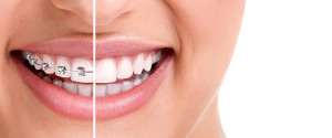 Crooked teeth remedies: fixed, mobile or invisible braces