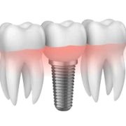 Implantology Milan