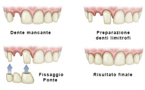 Ponte-dentale