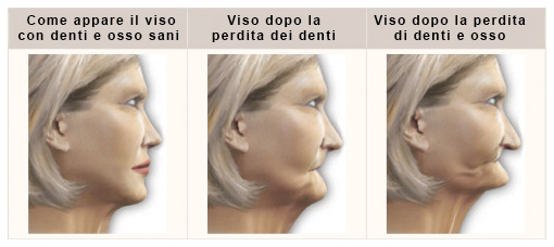 Phenomenon of bone resorption