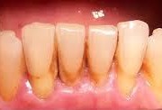 periodontitis, plaque and tartar