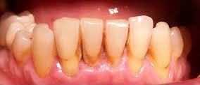 periodontitis, plaque and tartar