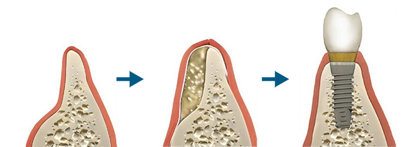 Bone graft