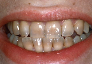 dental health: dental dyschromia