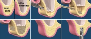 maxillary sinus lift