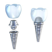 parts of a dental implant