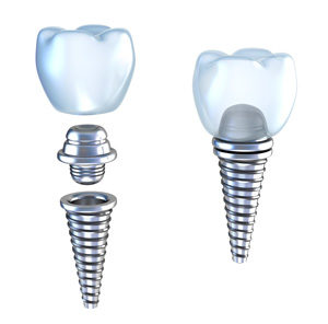 parts of a dental implant