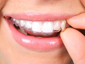 invisalign 1