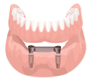 overdenture