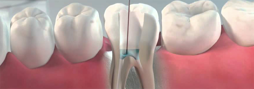 root canal treatment