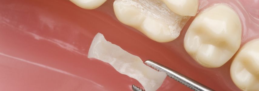 ricostruzione dentale