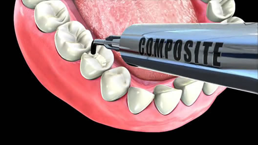 Ricostruzione dentale: quali differenze ci sono tra ceramica e compositi?