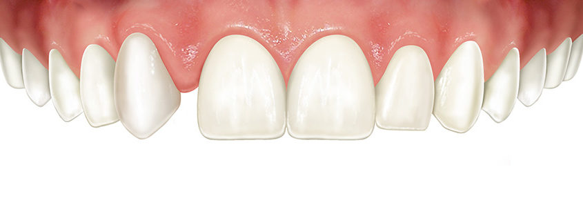 agenesia dentes permanentes agenesia dentes permanentes