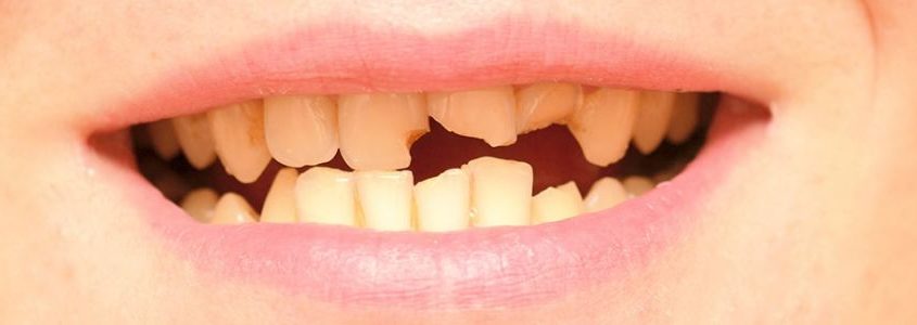 Frattura Del Dente Come Avviene E Quali Sono Le Possibili Cure