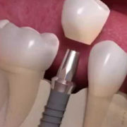 implantology in 24 hours