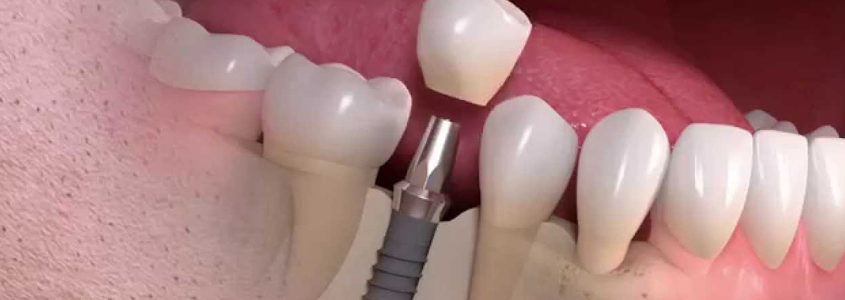 implantology in 24 hours