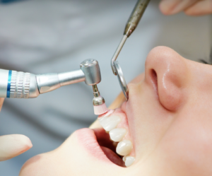 teeth cleaning