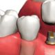history of implantology