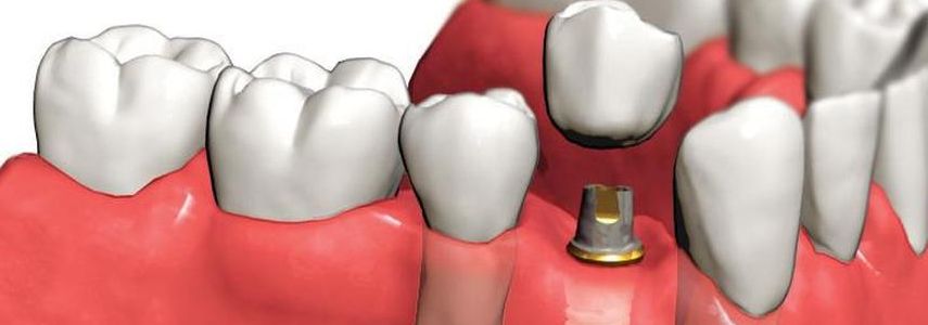 history of implantology