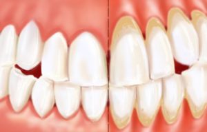 Gingival recession causes