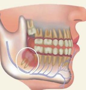 affollamento dentale