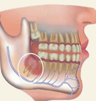 dental crowding