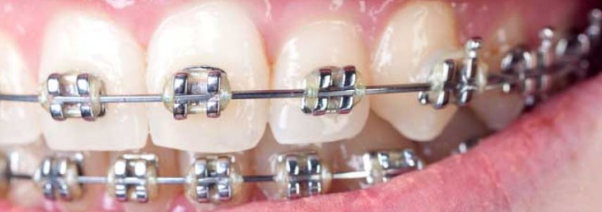 orthodontic appliance