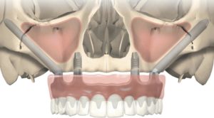 milan zygomatic implantology