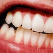 bruxism
