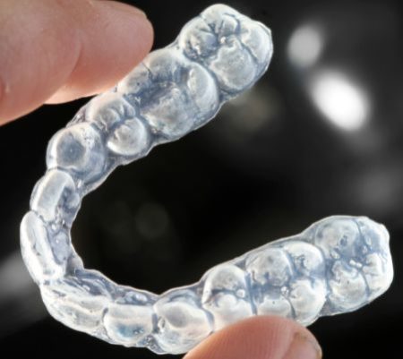 Bite dentale: quando e come si usa | Sanident - Milano