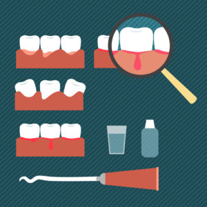 swollen gums causes