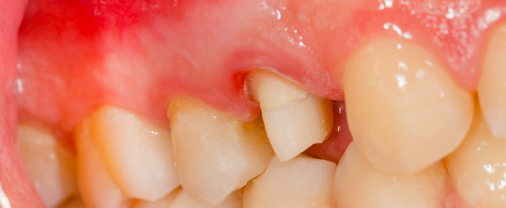 Gums - swollen Information