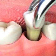 estrazione del dente