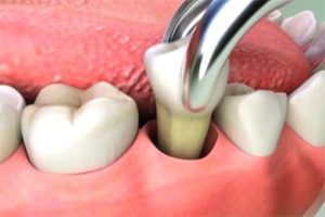 tooth extraction